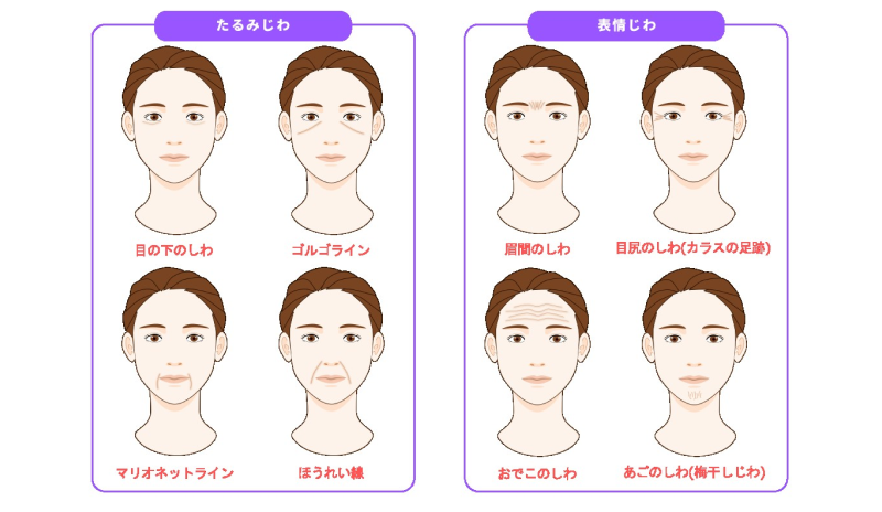 ACイラスト投稿　代表的なしわ